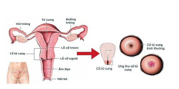 Ít nhất 75% phụ nữ cần được sàng lọc ung thư cổ tử cung